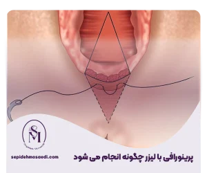 پرینورافی واژن با لیزر