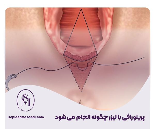 پرینورافی واژن با لیزر