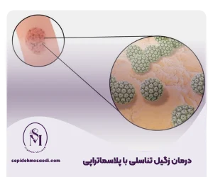درمان زگیل تناسلی با پلاسماتراپی