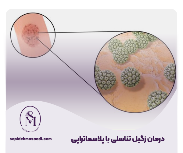 درمان زگیل تناسلی با پلاسماتراپی