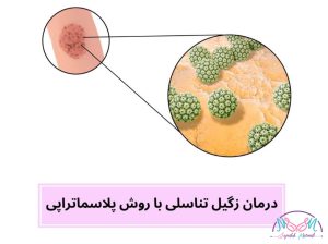 پلاسما تراپی زگیل تناسلی