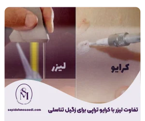 تفاوت کریوتراپی و لیزر زگیل تناسلی
