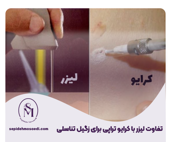 تفاوت کریوتراپی و لیزر زگیل تناسلی