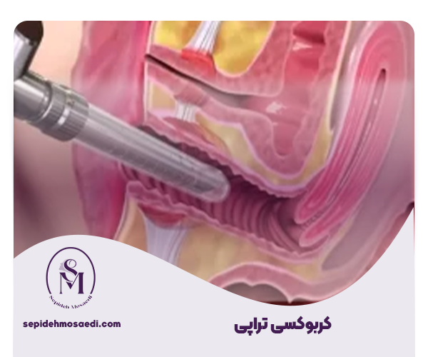 انواع روش های سفید کردن واژن 2 10 کربوکسی تراپی