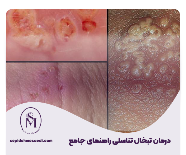 درمان تبخال تناسلی، انواع روشهای درمان دارویی و خانگی 1 درمان تبخال تناسلی راهنمای جامع