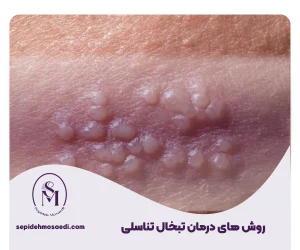 درمان تبخال تناسلی