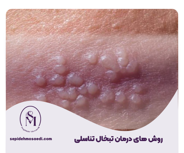 درمان تبخال تناسلی