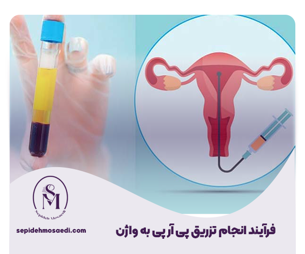 پی آر پی واژن چیست؟ راهنمای جامع بررسی PRP 3 چگونگی انجام تزریق پی آر پی به واژن