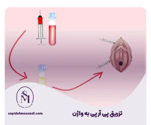 پی آر پی واژن