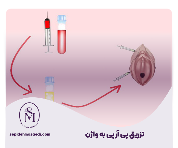 پی آر پی واژن