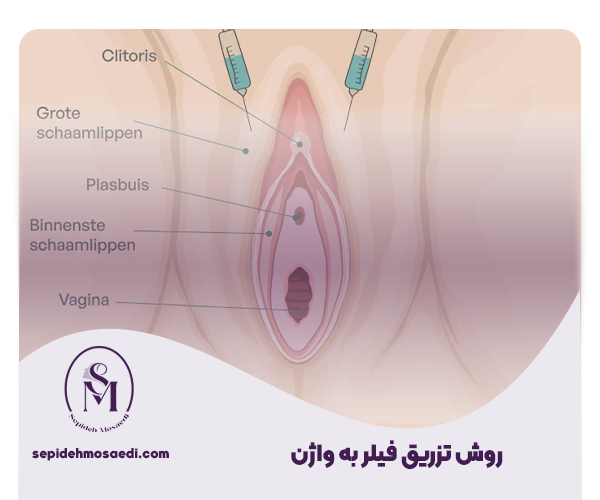 تزریق فیلر به واژن | عوارض، هزینه و ماندگاری 2 روش انجام تزریق فیلر به واژن