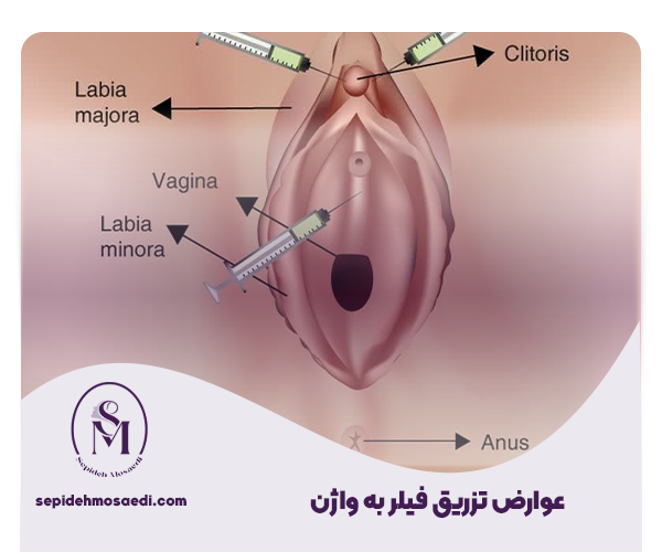 تزریق فیلر به واژن | عوارض، هزینه و ماندگاری 4 تزریق فیلر به واژن چه عوارضی دارد