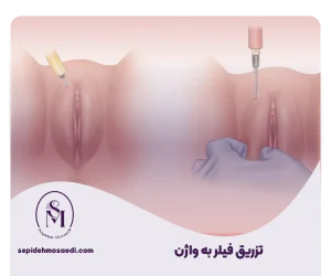 چگونگی تزریق فیلر به باسن