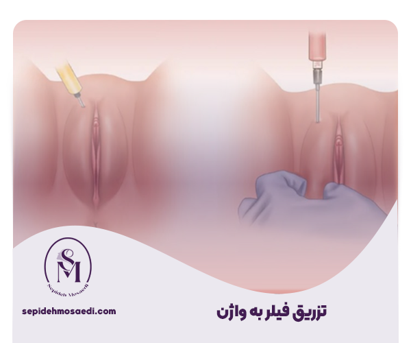 چگونگی تزریق فیلر به باسن