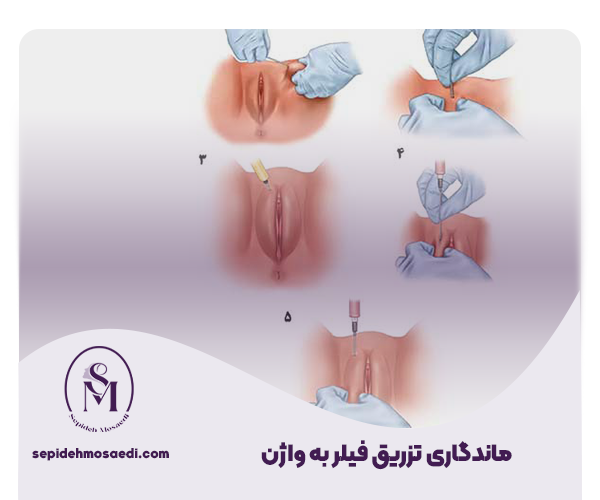 تزریق فیلر به واژن | عوارض، هزینه و ماندگاری 3 میزان ماندگاری تزریق فیلر به واژن