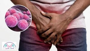 Chlamydia disease
