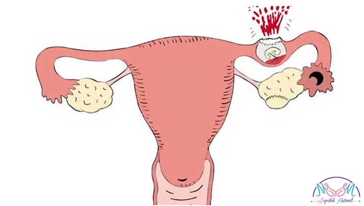 Ectopic pregnancy