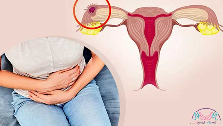 Ectopic pregnancy