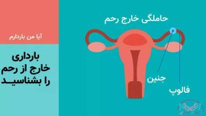 بارداری خارج از رحم