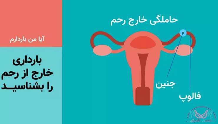 بارداری خارج از رحم