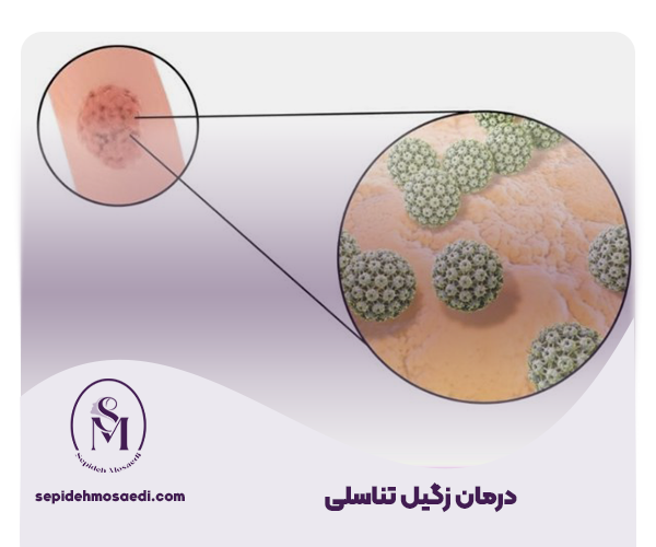 زگیل تناسلی؛ از شناخت ویروس HPV تا درمان کامل 4 درمان زگیل تناسلی