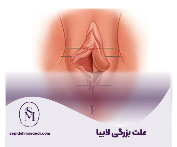 بزرگ شدن لابیا