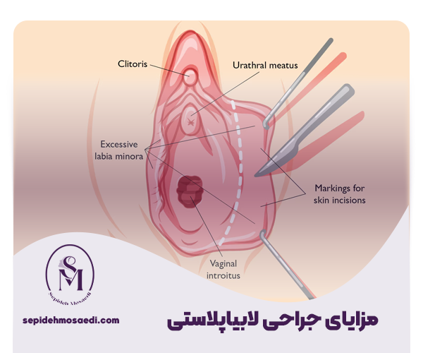 علت بزرگ شدن لابیا - روش های درمان بزرگ شدن لبه های واژن 3 مزایای جراحی لابیاپلاستی