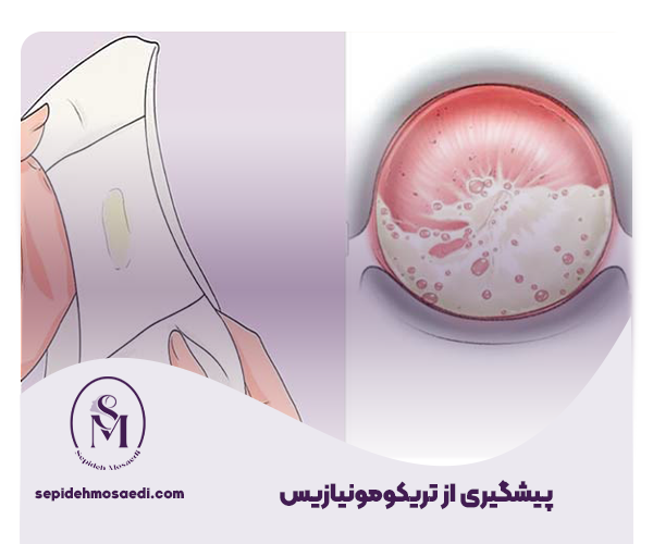 تریکومونیازیس چیست؟ علائم، انتقال، درمان و پیشگیری 4 پیشگیری از تریکومونیازیس