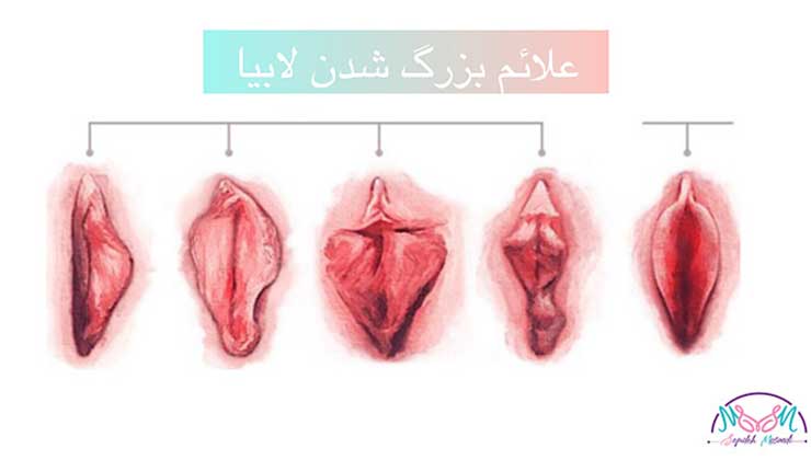 Causes of labia enlargement