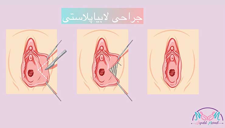 جراحی لابیاپلاستی