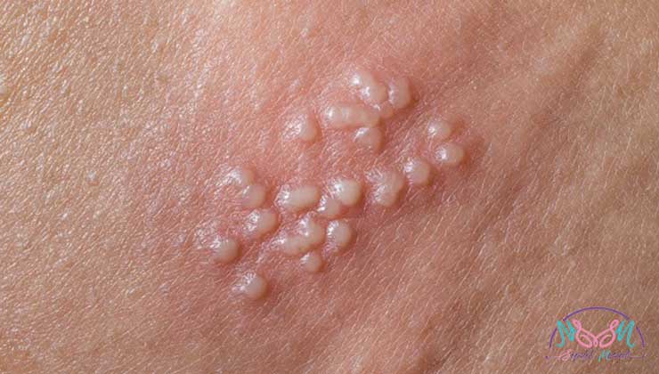 Genital herpes