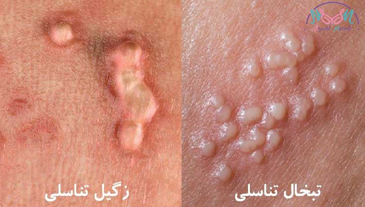 فرق تبخال و زگیل تناسلی