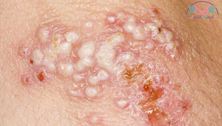 Genital herpes