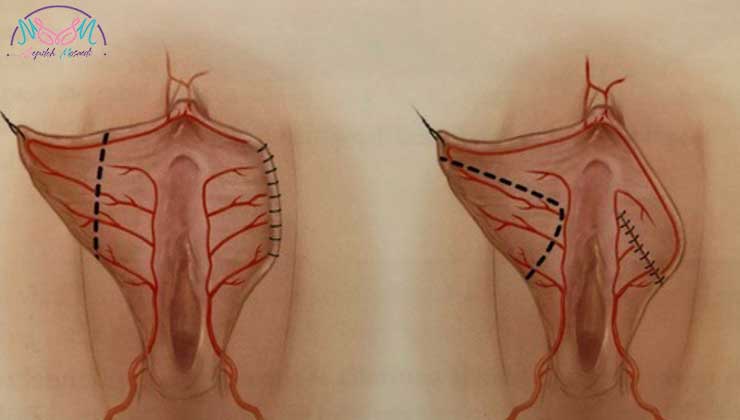 Labiaplasty suture