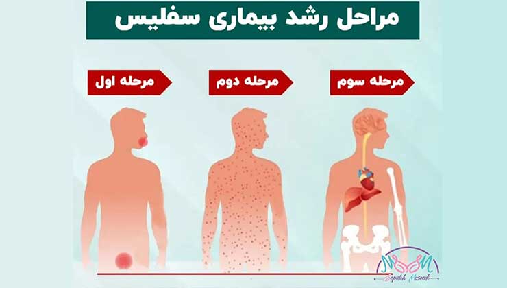 سیفلیس