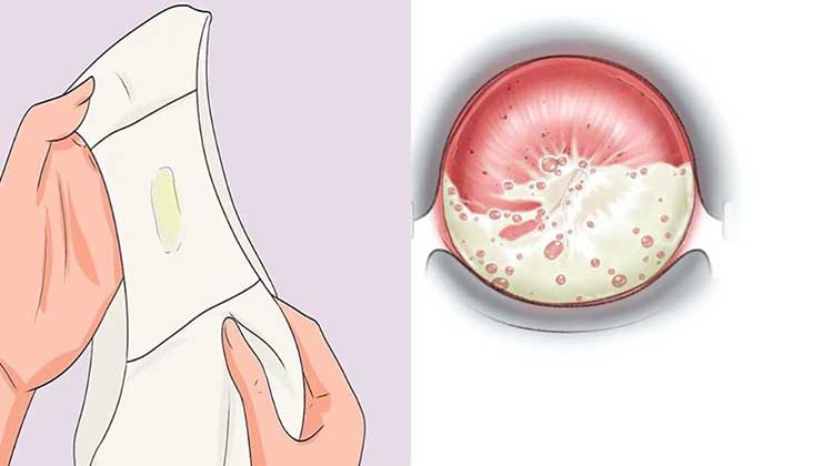 Trichomoniasis