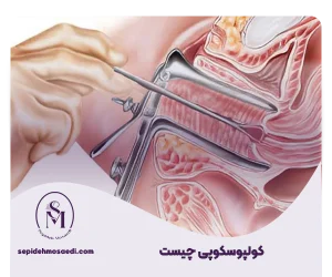 کولپوسکوپی چیست