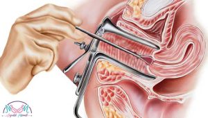 colposcopy