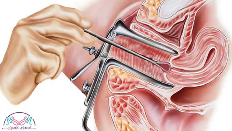 colposcopy