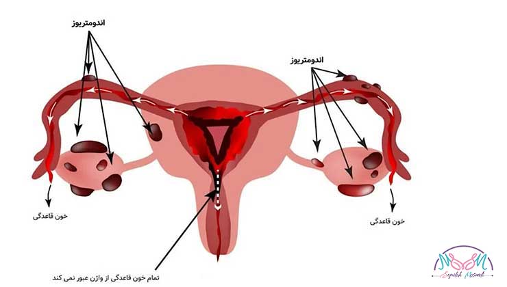 endometriosis