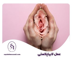 عمل لابیاپلاستی