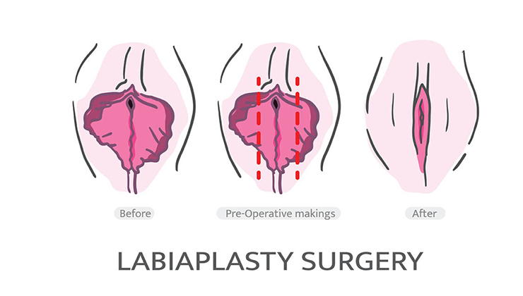 labiaplasty surgery