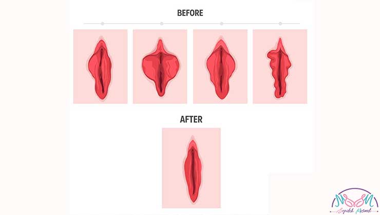 لابیاپلاستی با لیزر چگونه انجام می شود؟ 2 labiaplasty with laser 1