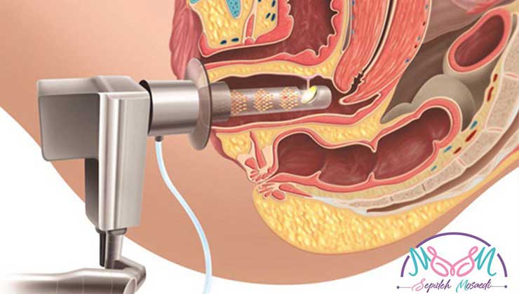 laser vaginoplasty
