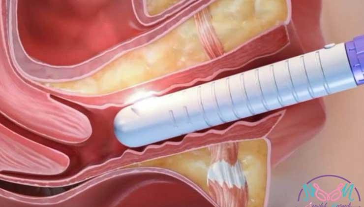 laser vaginoplasty
