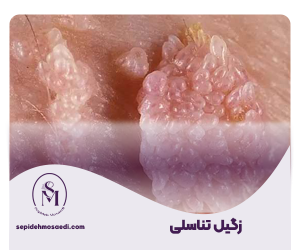 زگیل تناسلی؛ از شناخت ویروس HPV تا درمان کامل