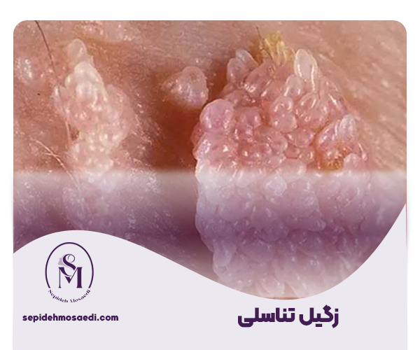 زگیل تناسلی؛ از شناخت ویروس HPV تا درمان کامل