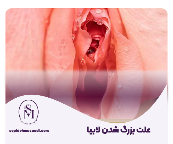 علت بزرگ شدن لابیا - روش های درمان بزرگ شدن لبه های واژن