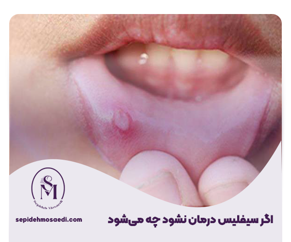 سیفلیس چیست؟ علائم vdrl چیست- راه های درمان 3 اگر سیفلیس درمان نشود چه میشود