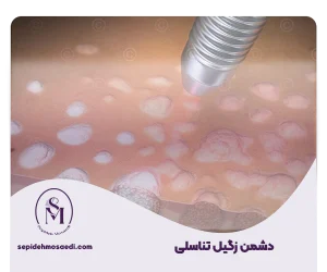 وبلاگ 11 زگیل تناسلی قطعی ترین درمان